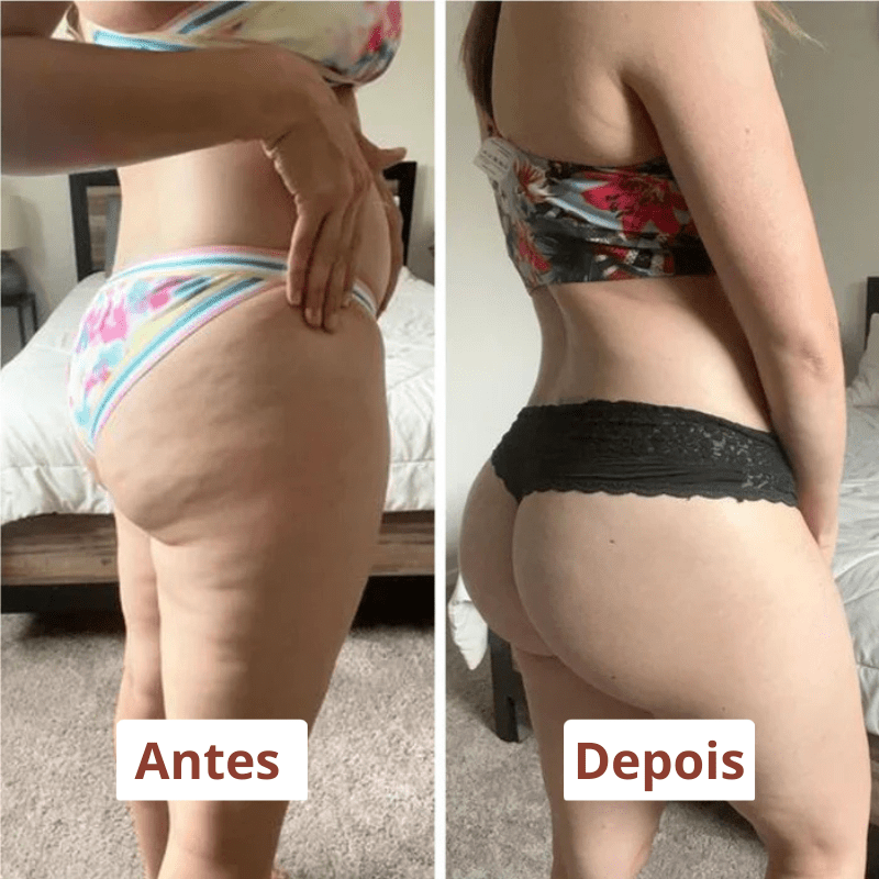 Drena Roller – Masajeador Linfático para Lipedema y Celulitis